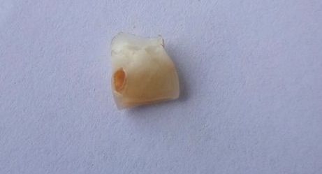 20170517昕昕换牙